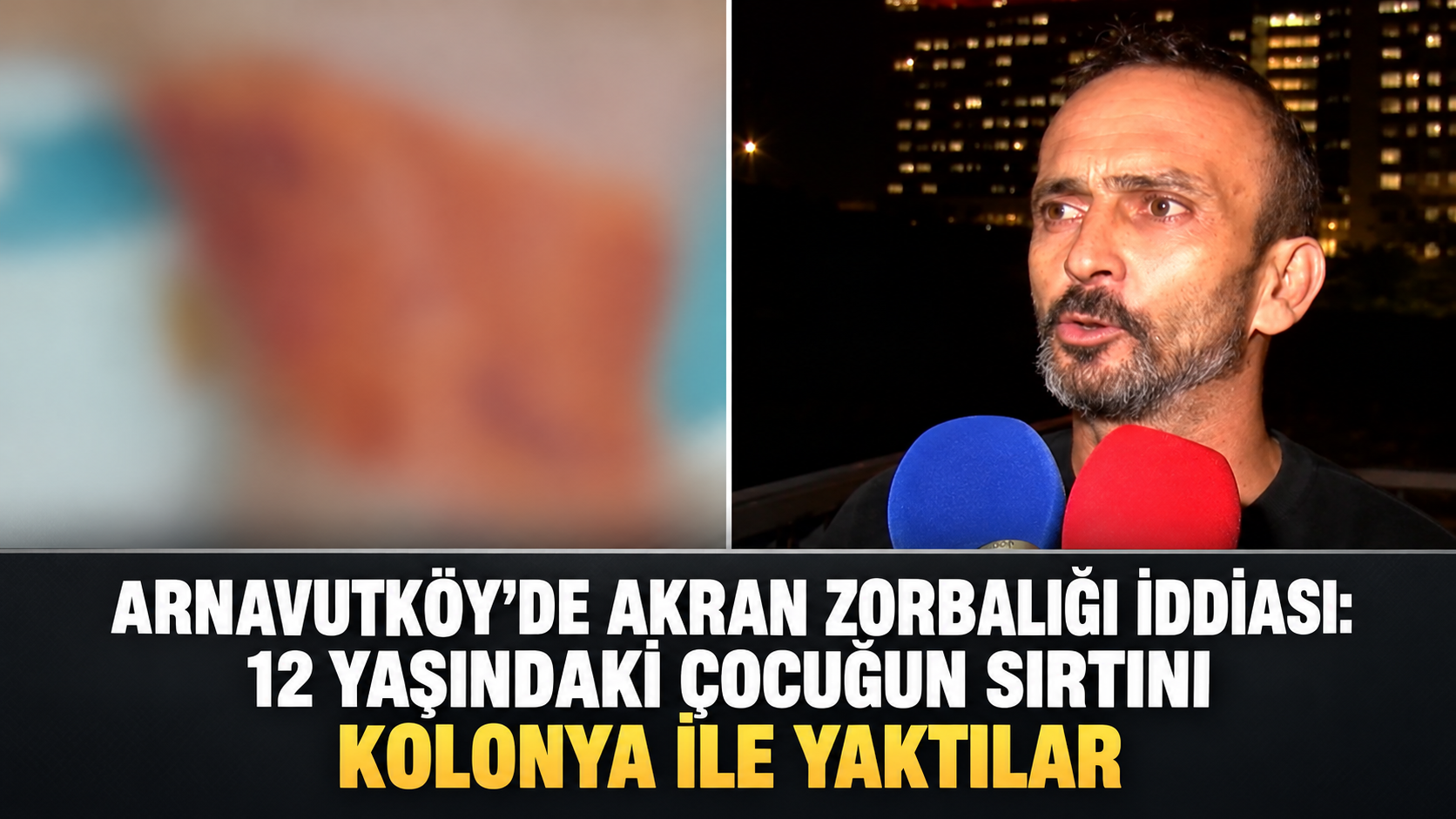 Arnavutköy'de akran zorbalığı iddiası: 12 yaşındaki çocuğun sırtını kolonya ile yaktılar